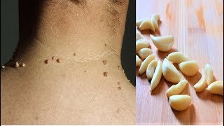 Remove Skin Tags  Home Remedies To Remove Skin Tags Easily [upl. by Rihsab431]