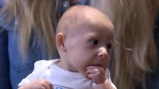 Matthew Kentucky baby born with rare form of dwarfism type II MOPD II [upl. by Hayse125]