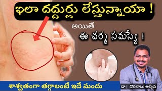 ఇంకెన్నాళ్లు ఇలా భాధ పడతారు  urticaria  skinallergy  allergy treatment dr dorababu appana tuni [upl. by Pressman215]