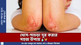 খোসপাচড়া দূর করার সহজ উপায় 🧴💆‍♀️ । All You Need to Know About Scabies [upl. by Ttayw710]