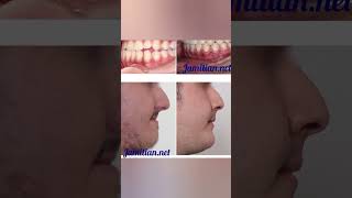 Before and After Orthodontic Treatment dentist bracing music dentalproblem openbite dentistry [upl. by Horter]