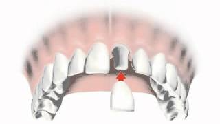 implantes dentales precios 2012  Consejos al Momento de Escoger implantes dentales precios 2012 [upl. by Eirruc]