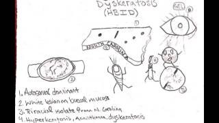 Hereditary Benign Intraepithelial Dyskeratosis [upl. by Neelrahc]