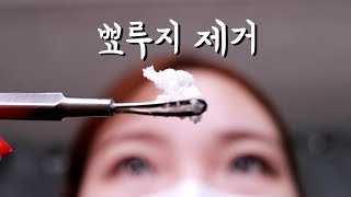 미니유 피부과 ASMR 톡톡 뾰루지제거│옛날목소리│Skin Care Role Play [upl. by Haimaj]