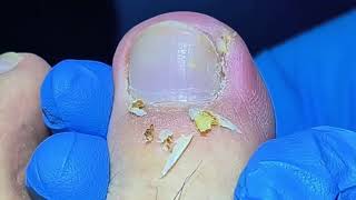 Removing Infected Ingrown Toenail [upl. by Hamish]