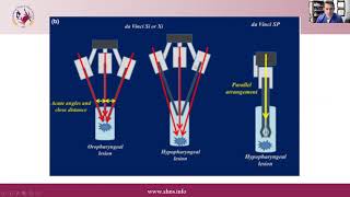 TORS for Larynx and Hypopharynx [upl. by Alahc]