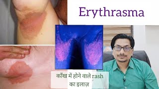 Erythrasma Black amp Red Spots in underarm below breast groin काँख में होने वाले rash का इलाज़ [upl. by Lammond]