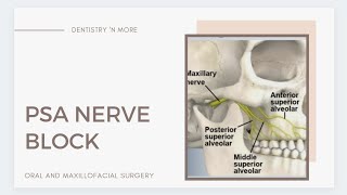 PSA POSTERIOR SUPERIOR ALVEOLAR  NERVE BLOCK [upl. by Umeh565]