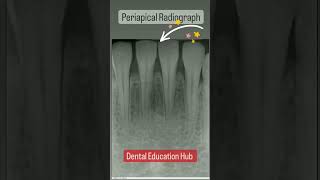 Periapical Radiograph  Dental Xray [upl. by Ainehs]