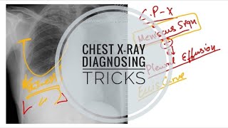 IMPORTANT Chest Xray Signs  Ellis Curve  HydroPneumothorax  Meniscus Sign [upl. by Margie]