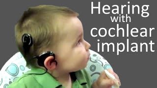 Deaf Baby Hears for the First Time with Cochlear Implant [upl. by Ahsitak883]