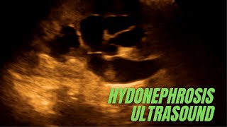 How to diagnose renal Hydronephrosis on ultrasound [upl. by Sac935]