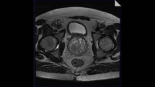 MRI Prostate Multiparametric  Axial T2 Space Isotropic [upl. by Teena]