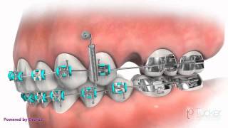 Orthodontic MiniImplant TAD or TSA [upl. by Rahas]