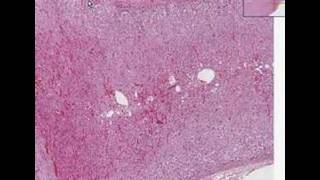 Histopathology AdrenalCortical adenoma [upl. by Langer962]