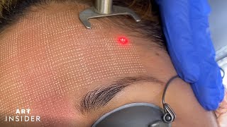 Minimize Acne Scarring With Laser Resurfacing [upl. by Akiv]