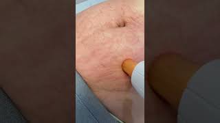 Stretch Mark Treatment  Laser Resurfacing [upl. by Oelak]