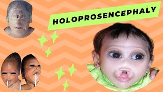 Holoprosencephaly  Causes  Symptoms  Diagnoses and Treatement [upl. by Regor]