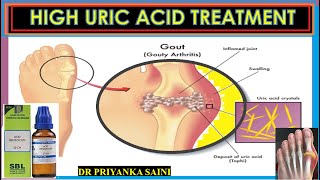 Hyperuricemia  High uric acid level in blood  HOMEOPATHY TREATMENT drpriyankashomeopathy [upl. by Neural]