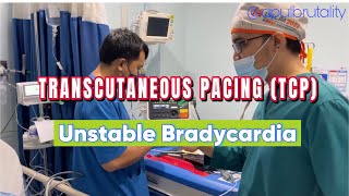 Emergency transcutaneous pacing TCP in unstable bradycardia [upl. by Arsuy]