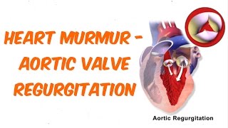 Aortic Regurgitation Auscultation Sound [upl. by Seumas]