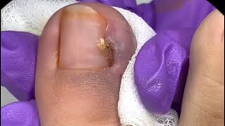 UNHA MUITO ENCRAVADAINGROWN TOENAIL  nails manicure unhaencravada [upl. by Ellimaj]