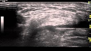 Ultrasound guided Injection of the Suprapatellar pouch Knee Dr Peter Resteghini [upl. by Suiramad325]