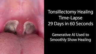 Healing Time Lapse After Tonsillectomy 029 Days in 60 Seconds [upl. by Einhpad48]