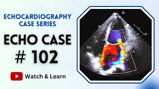 ECHO Case 102  Echocardiography for Beginners  Echocardiogram Interpretation [upl. by Jeremie]