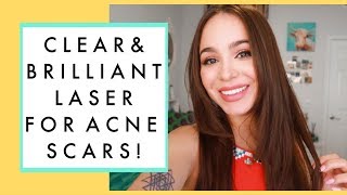 LASER TREATMENT FOR ACNE SCARS My 2 Week Progress [upl. by Wilmer]