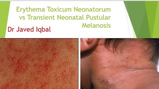 Erythema Toxicum Neonatorum VS Transient Neonatal Pustular Melanosis [upl. by Mackenzie506]