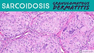 Sarcoidosis amp Granulomatous Dermatitis Pattern  Inflammatory Dermatopathology Basics [upl. by Shelba252]