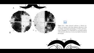 Kanski Clinical Ophthalmology Made Easy  Neuroophthalmology 11 Retrochiasmal Lesion [upl. by Kippie812]