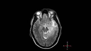 Gliomatosis cerebri [upl. by Corry]