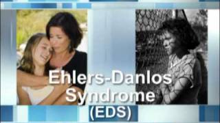 What Is EhlersDanlos Syndrome [upl. by Litsyrk140]