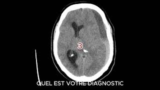 HEMATOME SOUS DURAL CHRONIQUE radiologystudent hospitalityeducation [upl. by Aerdnua]