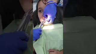 PainFree Tooth Extraction What to Expect Under Local Anesthesia [upl. by Siron]