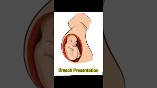 Breech presentation vs cephalic presentation [upl. by Ytsanyd396]