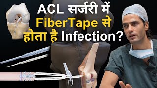 ACL सर्जरी में FiberTape से होता है Infection Does FiberTape causes Reaction in ACL Surgery [upl. by Darra]