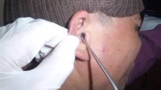 Earwax Removal and Suctioning of Ear Fungus Otomycosis [upl. by Engud]