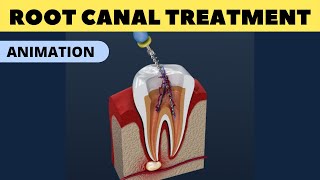 Root canal procedure [upl. by Femi654]