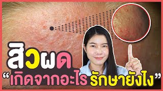 สิวผดเกิดจากอะไร วิธีรักษาสิวผดเร่งด่วนด้วยตัวเอง Noninflammatory Acne  แนน Sister Nan [upl. by Lsil]