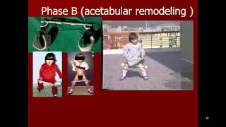 Educational video for the treatment of developmental dysplasia of hip without surgery [upl. by Sheeb88]