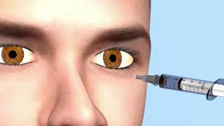 Ocular surgery Local anesthesia [upl. by Sitoel]