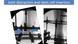 Subtalar Distraction for Treatment of Subtalar Joint Arthritis Two Patients [upl. by Nitsrik318]