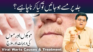 Viral Warts Causes amp Treatment  Skin Ke Masse Ka Ilaj  Warts On Face Hand amp Feet Removal [upl. by Aisemaj59]