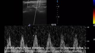 CASE 544 Carotid artery Pulsus bisferiens [upl. by Onidranreb974]