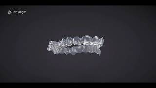 Invisalign Treatment With Mandibular Advancement [upl. by Rip]