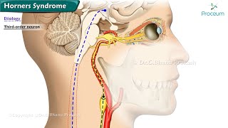 Horners Syndrome  Etiology  Classification  Diagnosis  Treatment [upl. by Ramgad878]