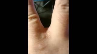 My scabies symptoms [upl. by Ailedo164]